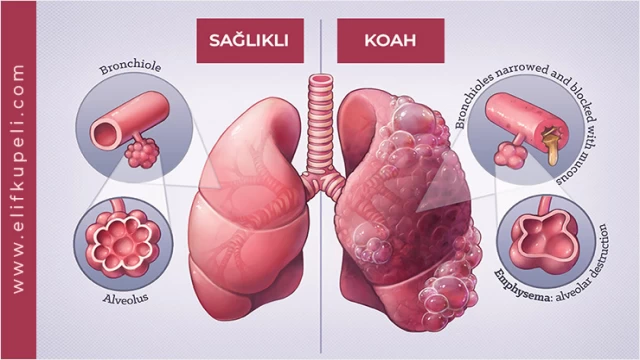 KOAH, ölüm oranı en hızlı artan hastalık