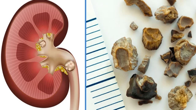 Böbrek taşı neden olur nasıl düşürülür